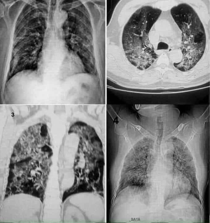 phổi người sau khi bị mắc covid-19